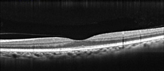 正常な網膜断面：黄斑は中心がへこんだ構造をしている