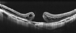 黄斑円孔の網膜断面：黄斑に穴があいている状態。穴が徐々に広がると中心部分の見えない範囲が拡大する。