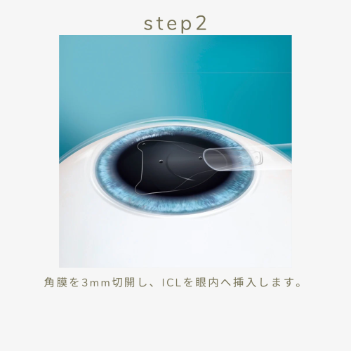 手術方法step2