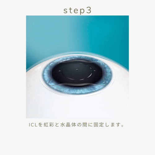 手術方法step3